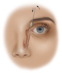Lacrimal cyst operations-ZEC